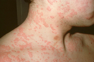 Сыпь на коже инфекционного характера