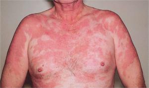 Туберкулёз кожи