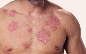 Как лечить туберкулез кожи