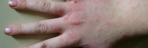 Аллергия на руках: виды