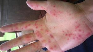 Аллергия на руках 
