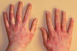 Аллергия на руках - способы лечения