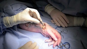 Оперативное вмешательство для лечения гигромы на руке