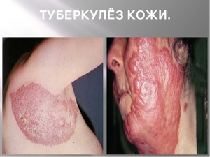 Причины туберкулеза кожи