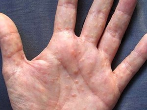 Дисгидроз кистей рук: причины