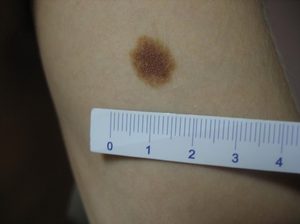 Диагностика заболевания на коже человека