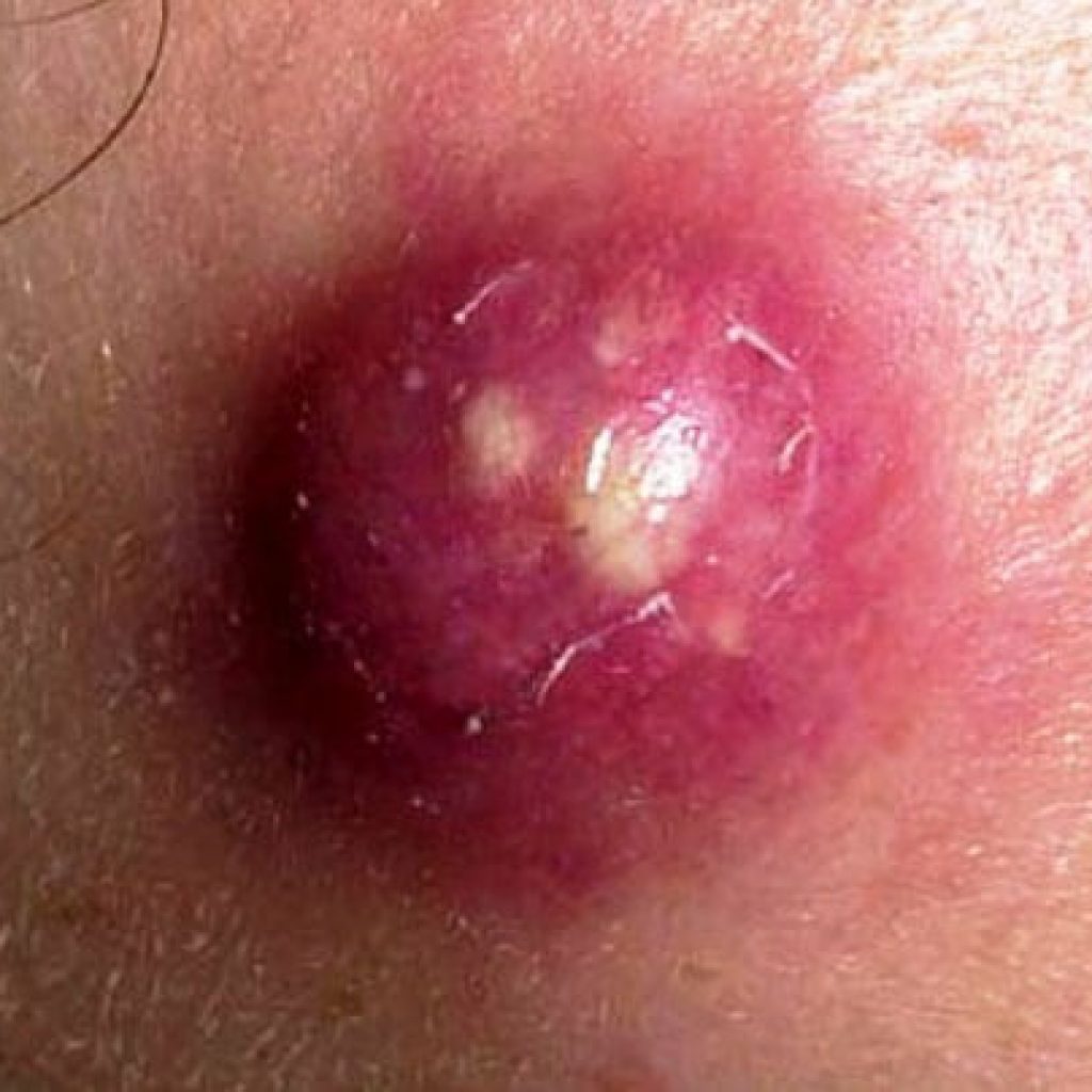 фурункул на груди у женщин лечение фото 64