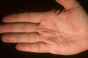 При дисгидрозе кожа на кистях рук утолщается, становится грубой