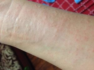 Аллергия на руках