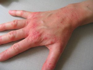 Почему возникает дерматит на руках