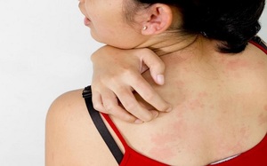 Причины и симптомы аллергического дерматита