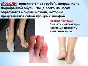 Лечение мокрой мозоли на пальцах ног