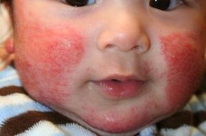 Аллергия у ребенка