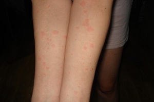 Причины появления аллергии