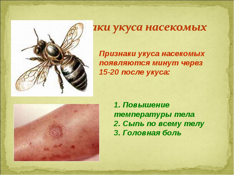 Какие отношения между крапивницей и пчелой. Укусы мошек комаров слепней. Симптомы при укусах насекомых. Аллергическая реакция на укус насекомого.