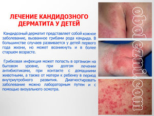 Мнение Комаровского о дерматите