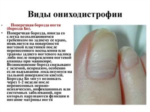 Лечение ониходистрофии ногтей
