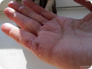 Атопичная кожа лица лечение thumbnail