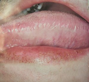 Волосистая лейкоплакия на боковой поверхности языка
