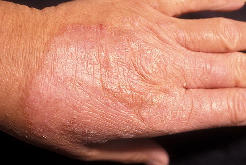 Грибковые заболевания кожи симптомы и лечение