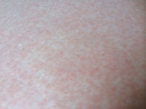 Аллергия на животе: причины, симптомы, лечение