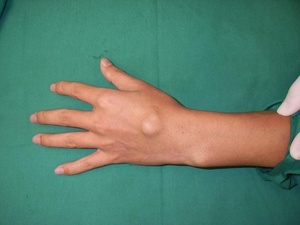 Описание патологии гигрома на кисти руки