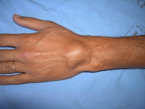 Чем опасно кистозное новообразование на руке